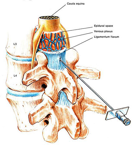 Epidural steroid injection in neck side effects