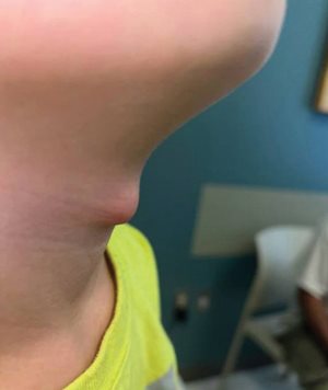 thyroglossal duct cyst