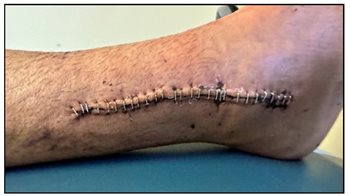 fracture, ankle, surgical staples