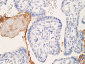 covid fetal demise