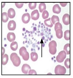 thrombocytopenia