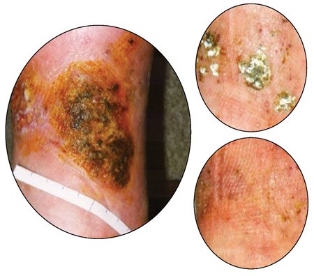 venous stasis ulcer healing