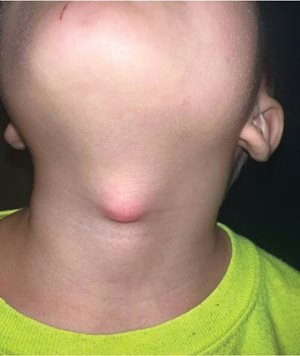 thyroglossal duct cyst