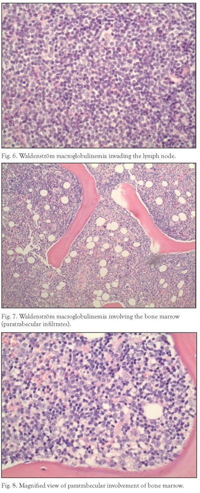 waldenstrom macroglobulinemia