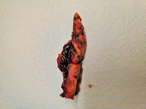 covid fetal demise