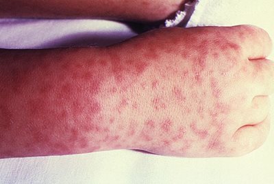 spotted fever rash