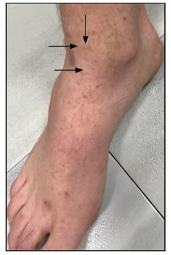 thrombocytopenia