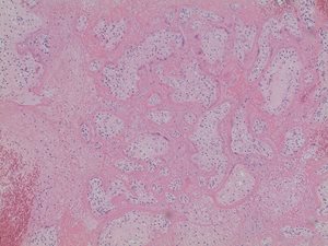 covid fetal demise