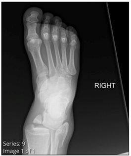 fracture, foot