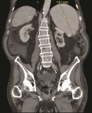 thrombocytopenia