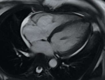 ventricular tachycardia